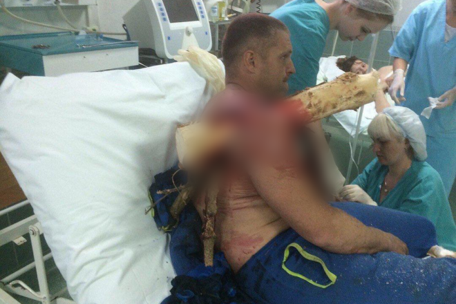‘Log in shoulder’: Belarus paraglider posts shocking photos of injury