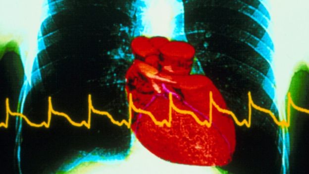 Как распознать "тихий инфаркт"? И можно ли его вообще не заметить?